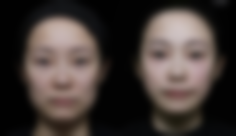 如何快速去除眼袋?挑选靠谱医院保护成效