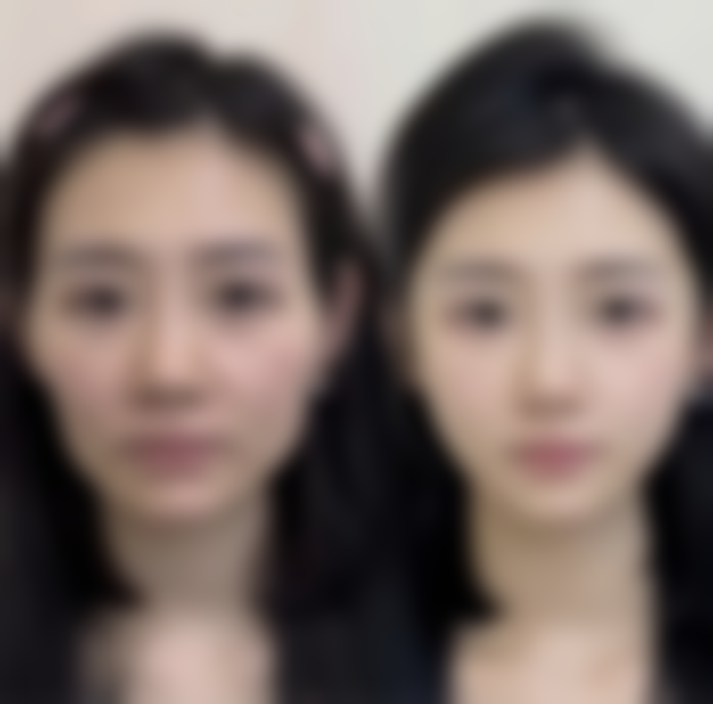 切开双眼皮留疤几率大吗？术后护理对疤痕程度的影响