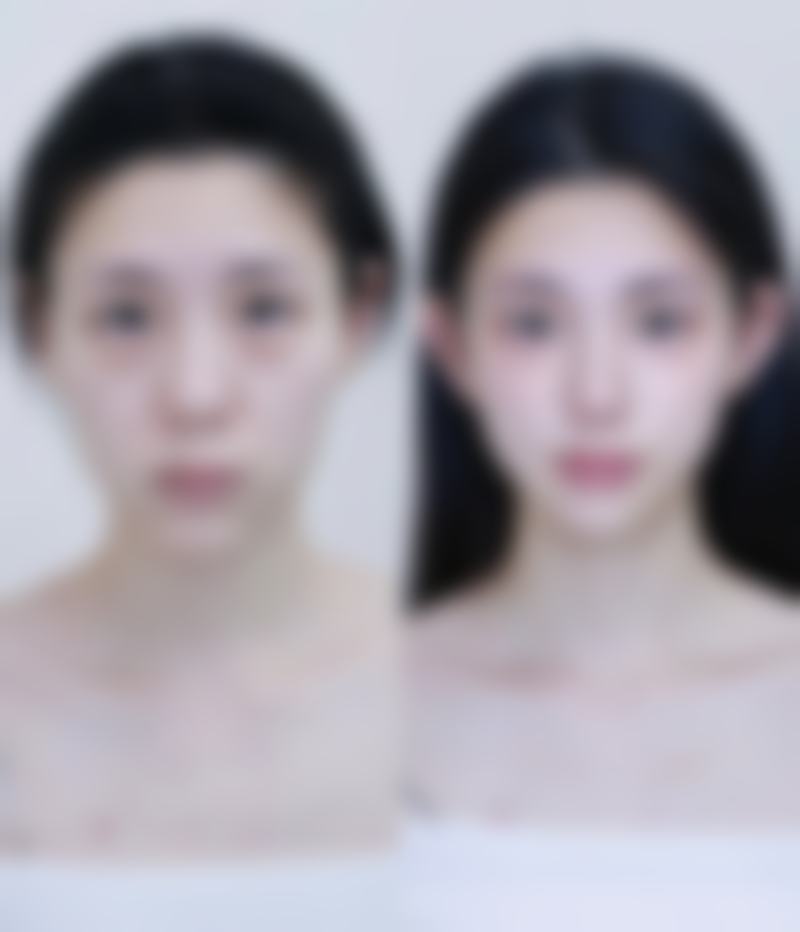 如何快速去除眼袋?手术方案解决中重度难题