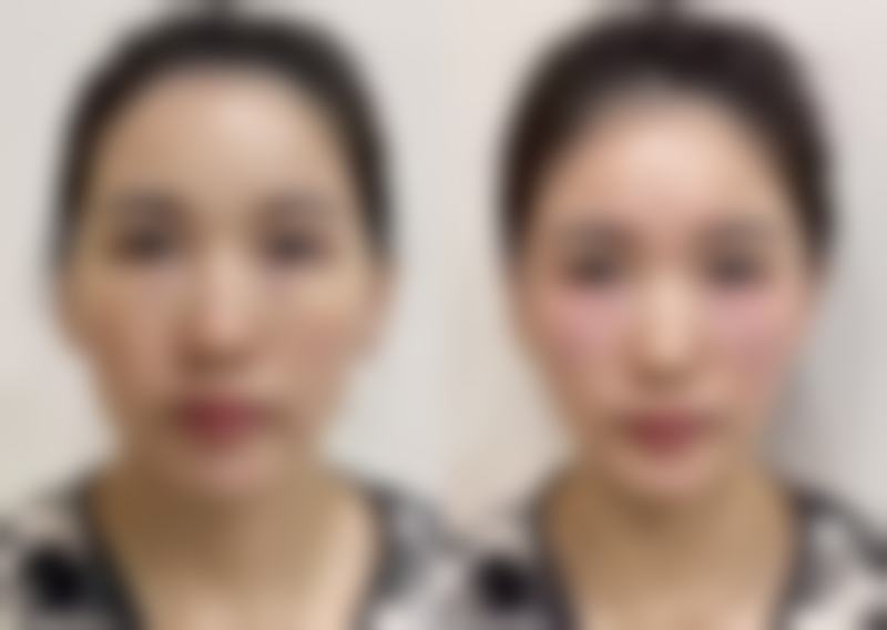 切开双眼皮留疤几率大吗？医生技术对疤痕程度的影响