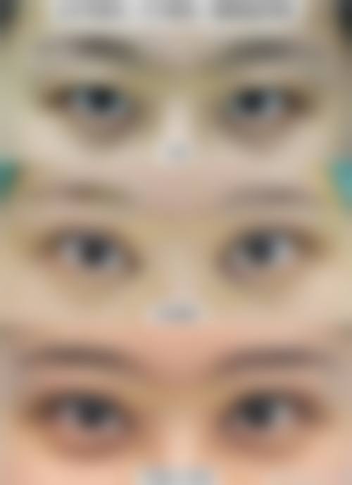 王玄宇眼部整形实例