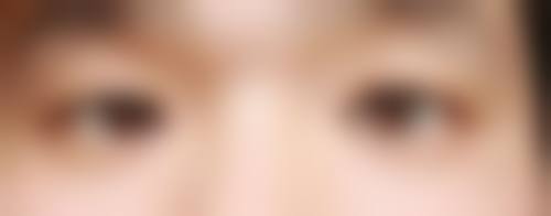 李婧宇眼整形实例