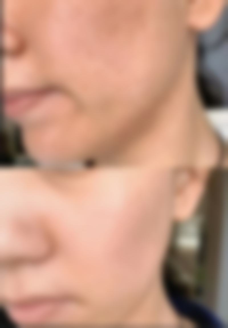 做隆胸多久能修复自然?中期修复情况