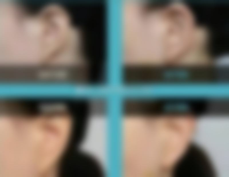 割了双眼皮修复自然还受个人体质影响