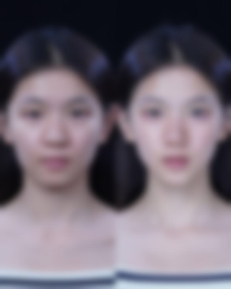 探索下眼袋消除秘籍:选择靠谱的医美机构,保护治疗安心与成效