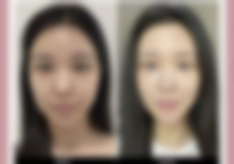 了解隆胸后日常触碰的手感体验：舒适自然，近乎真胸