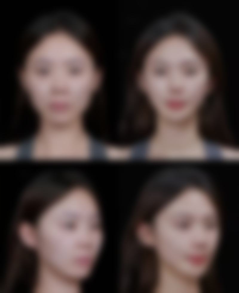 割了双眼皮修复自然时间与护理方式相关