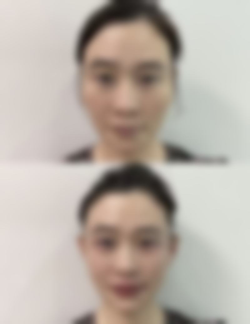 割双眼皮后何时能洗脸?拆线前的护理与清洁