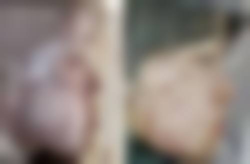 烫伤疤痕咋应对？多阶段方案来助力