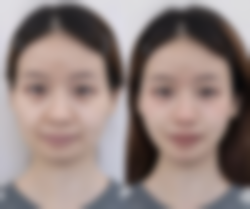 隆鼻方式的优缺点再深入剖析!