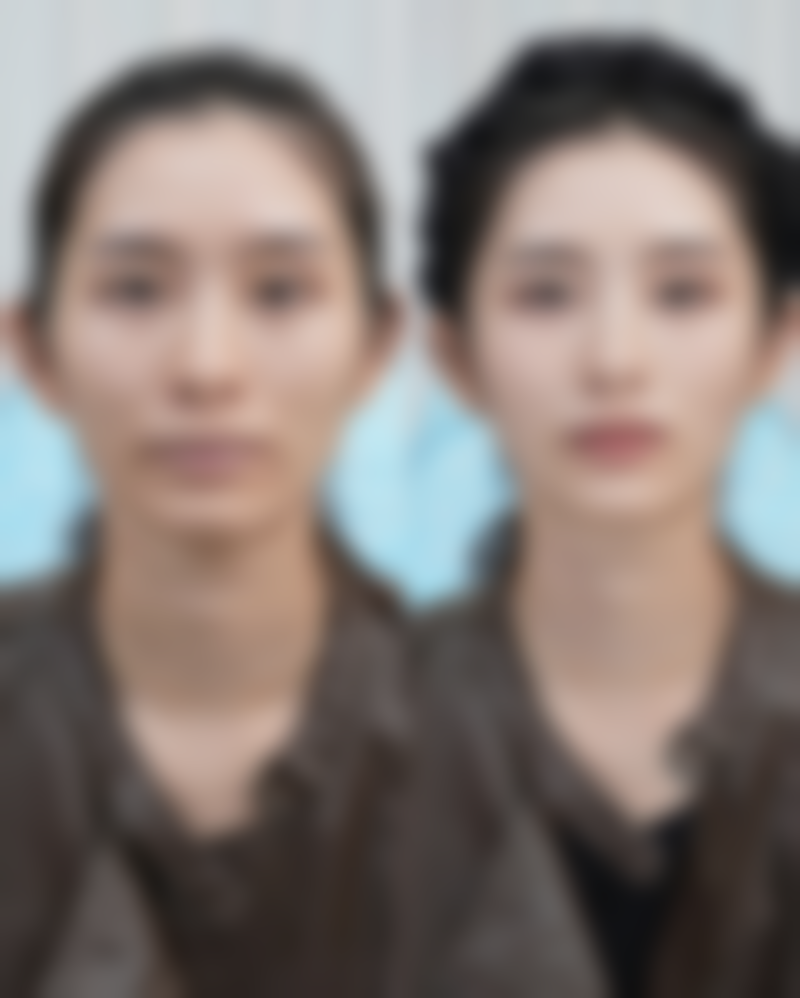 面部吸脂术有靠谱医生保护吗？专精团队助力美丽蜕变