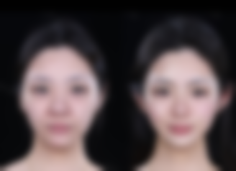 面部吸脂术效果究竟如何？分区精细操作，术后成效自然皮肤紧致还持久