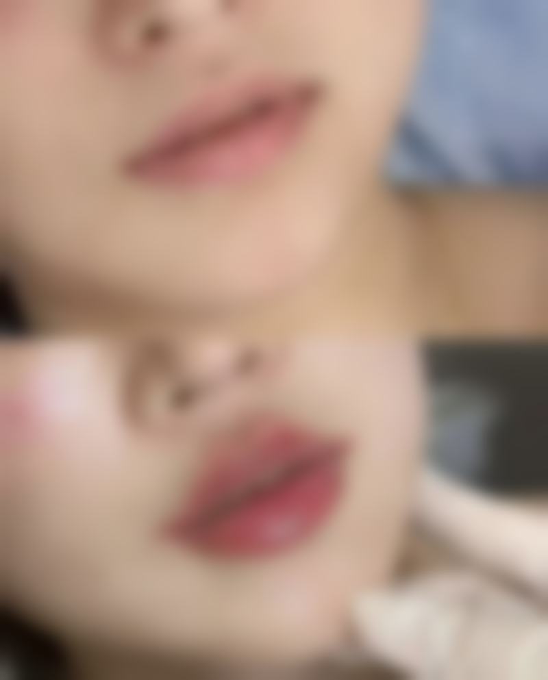 烫伤疤痕治疗有信心，重塑光滑肌肤不是梦