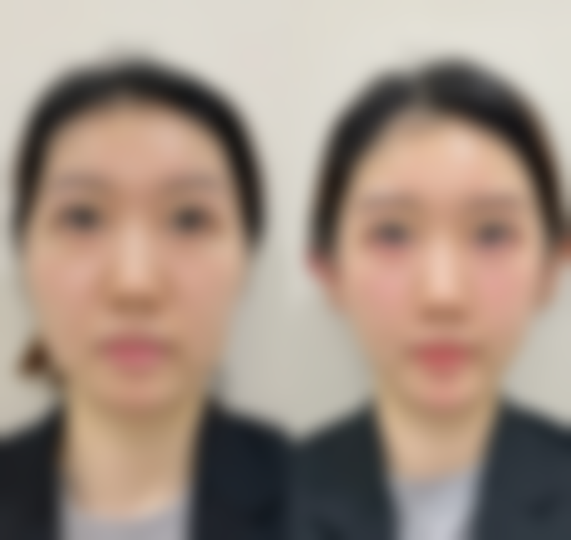 割双眼皮第二天护理要点大揭秘:清洁伤口,预防感染