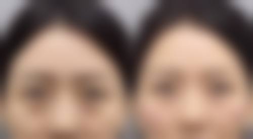 强调术后护理对割双眼皮红色疤痕消退的重要性