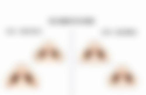 割双眼皮前,生活习惯要调整!良好状态迎接手术