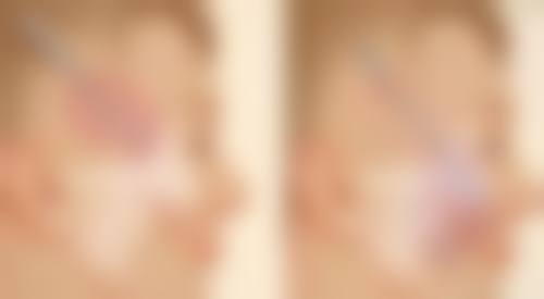 甲状腺手术后疤痕增生,优质医院怎么选?靠谱医院助力焕新颜