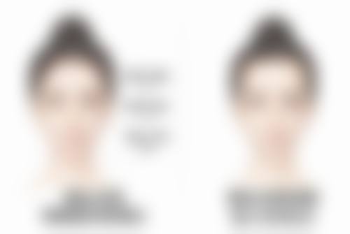 手臂抽脂何时恢复正常？3 - 6 个月达稳定，多因素影响恢复速度与效果 