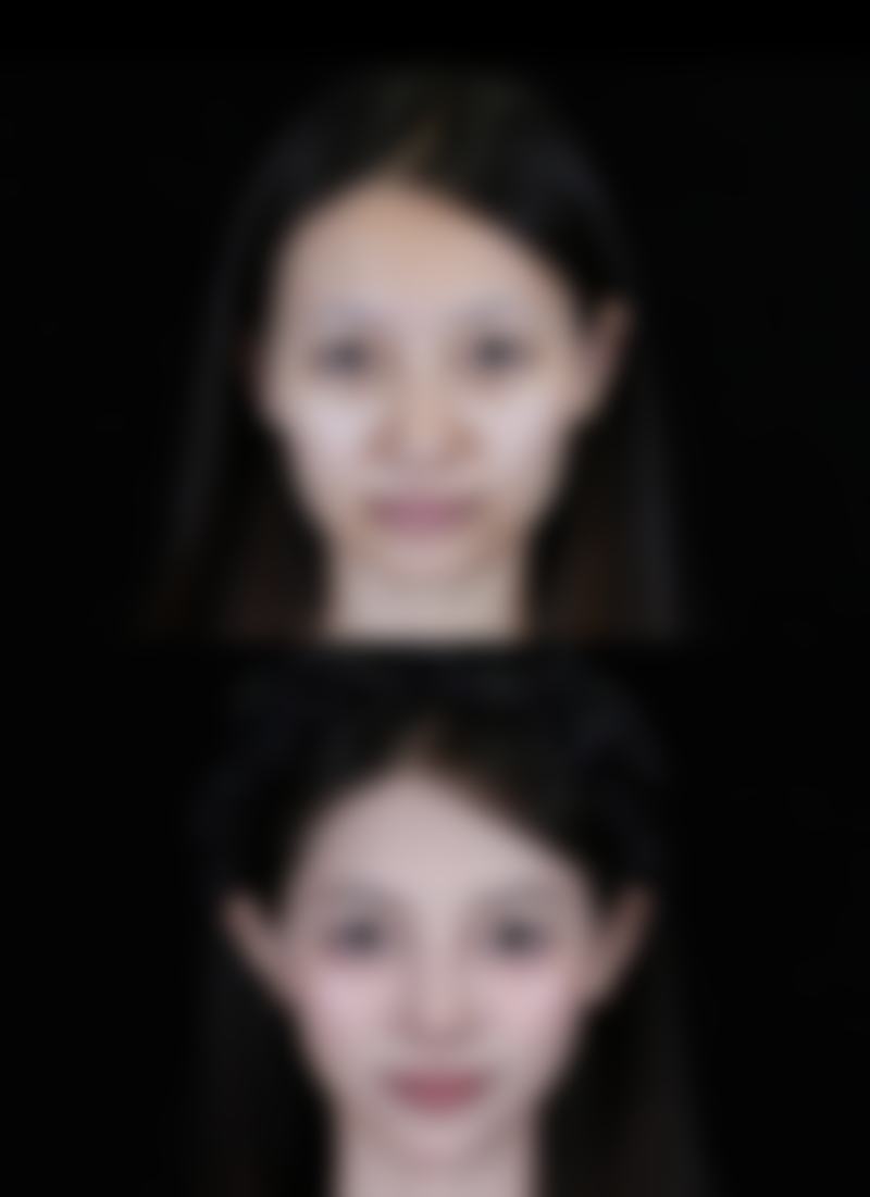 甲状腺手术后疤痕增生不用怕,积极治疗焕新颜