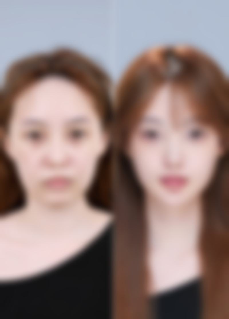 探讨不同手术方式对割双眼皮红色疤痕消退的影响