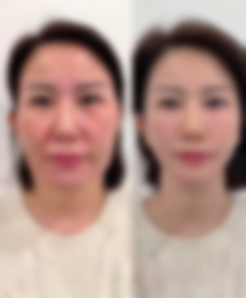 包皮手术疤痕用药注意事项及辅助改善方法:多管齐下成效好