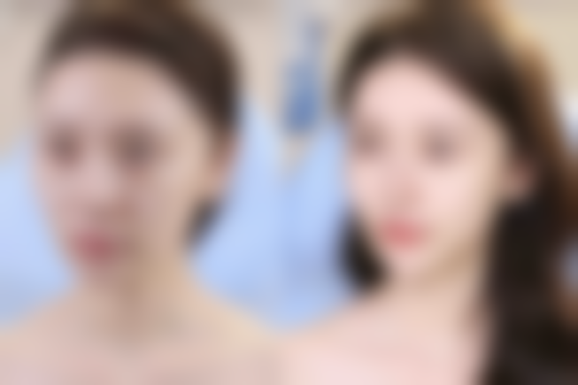 包皮手术疤痕常用药之硅酮类凝胶:早期祛疤好帮手