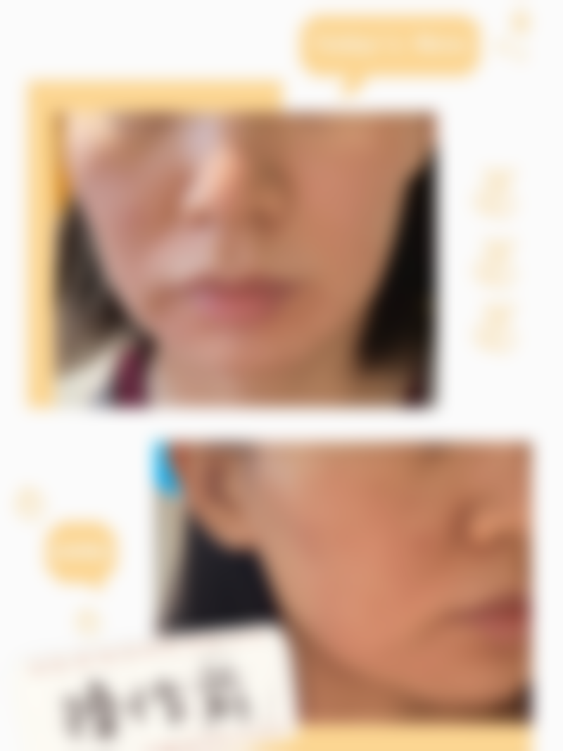 30岁抗初老！我在广东韩妃做半岛超声炮，舒适无痛0恢复期效果超棒 