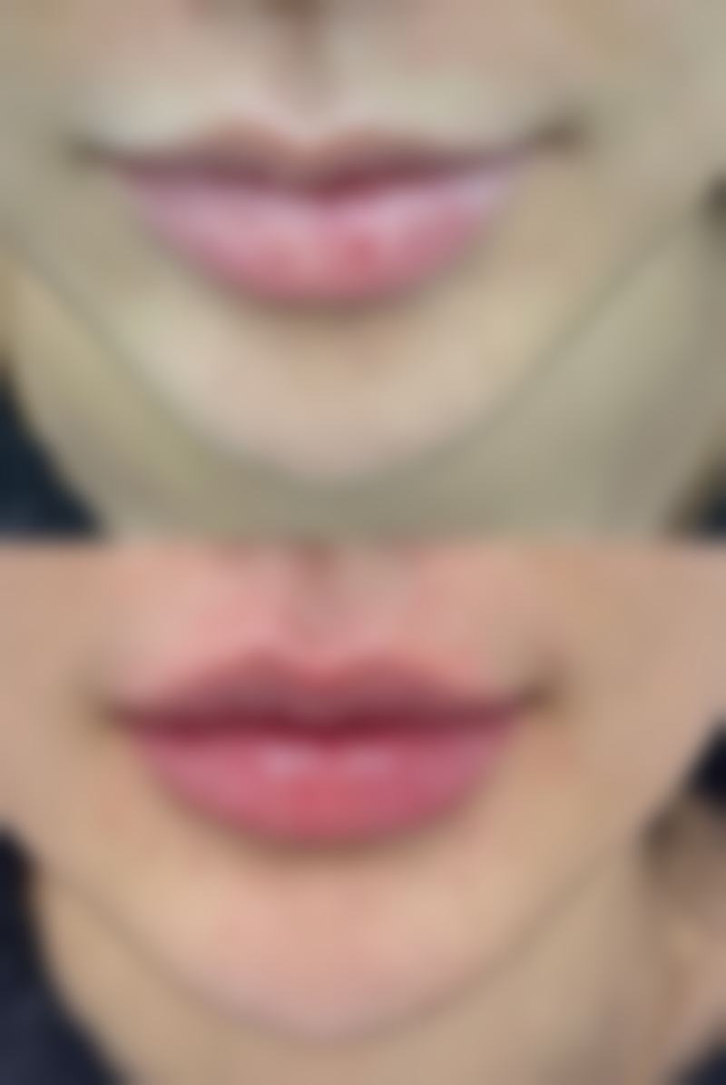 如何巧妙变内双:靠谱医院推荐