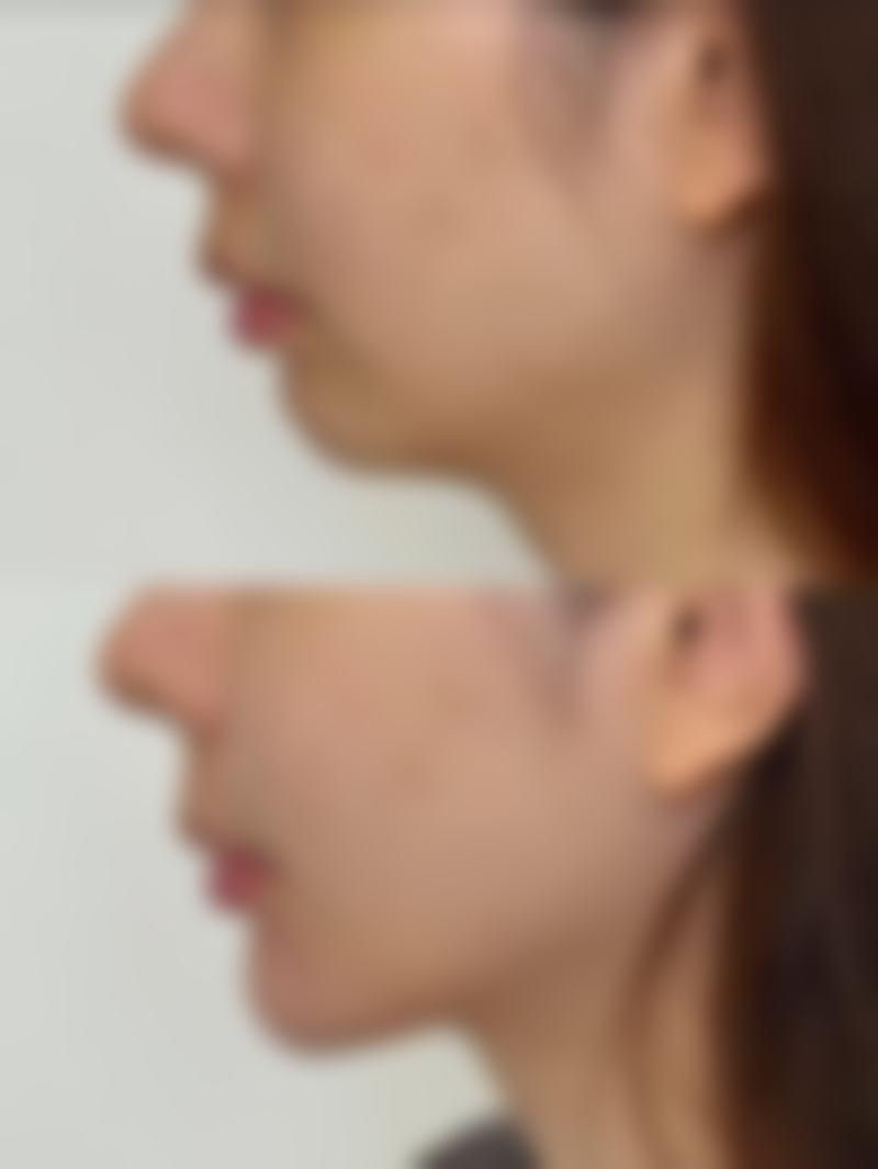 四、上海虹桥医院私密整形科实例