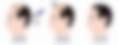 筋膜恒久无痕双眼皮的多种实现方式