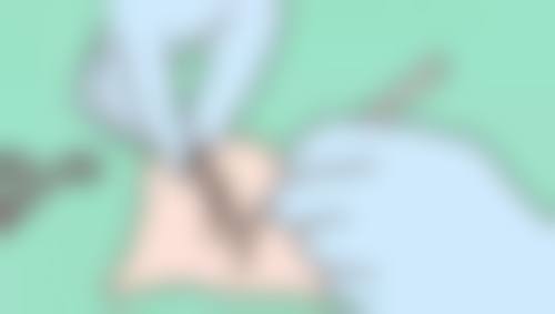 如何巧妙去除缝针后的疤痕疙瘩？综合治疗+美学护理助力肌肤恢复平整柔和