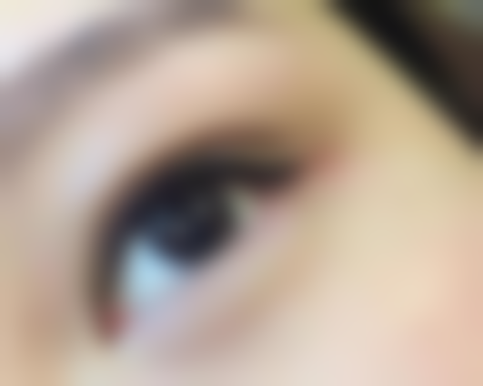 怎样去眼袋效果最好？分型而治、多法结合，还你明亮双眸与自然眼周曲线 