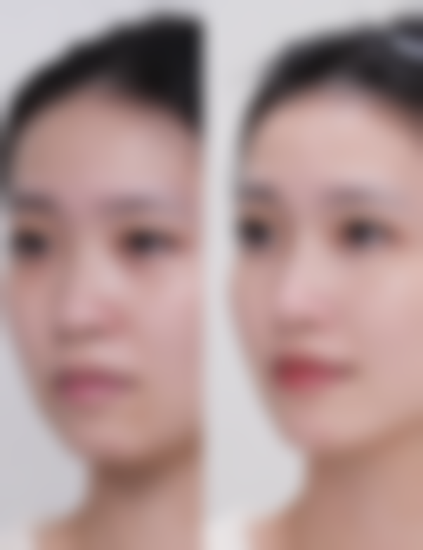 筋膜恒久无痕双眼皮术后的修复与成效