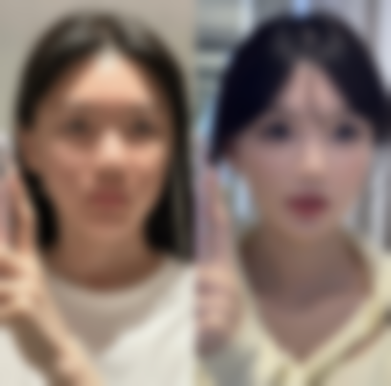 丰太阳穴：修复期对比