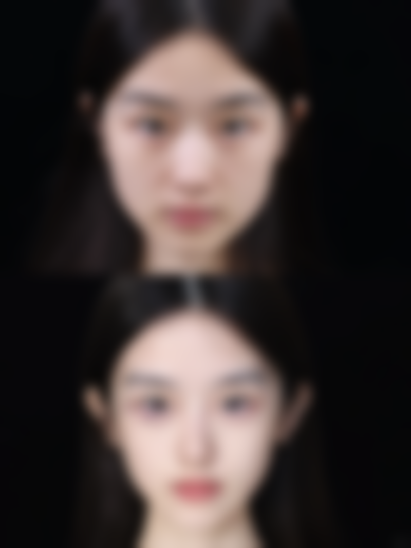 筋膜恒久无痕双眼皮的价格与性价比