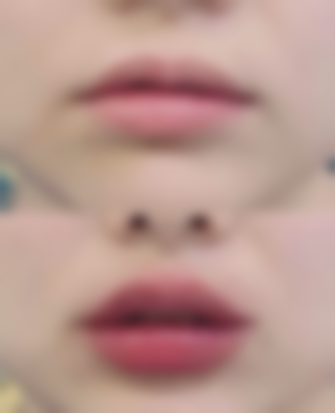 丰太阳穴选玻尿酸、自体脂肪还是胶原蛋白？对比优势助你挑到适配填充材料 