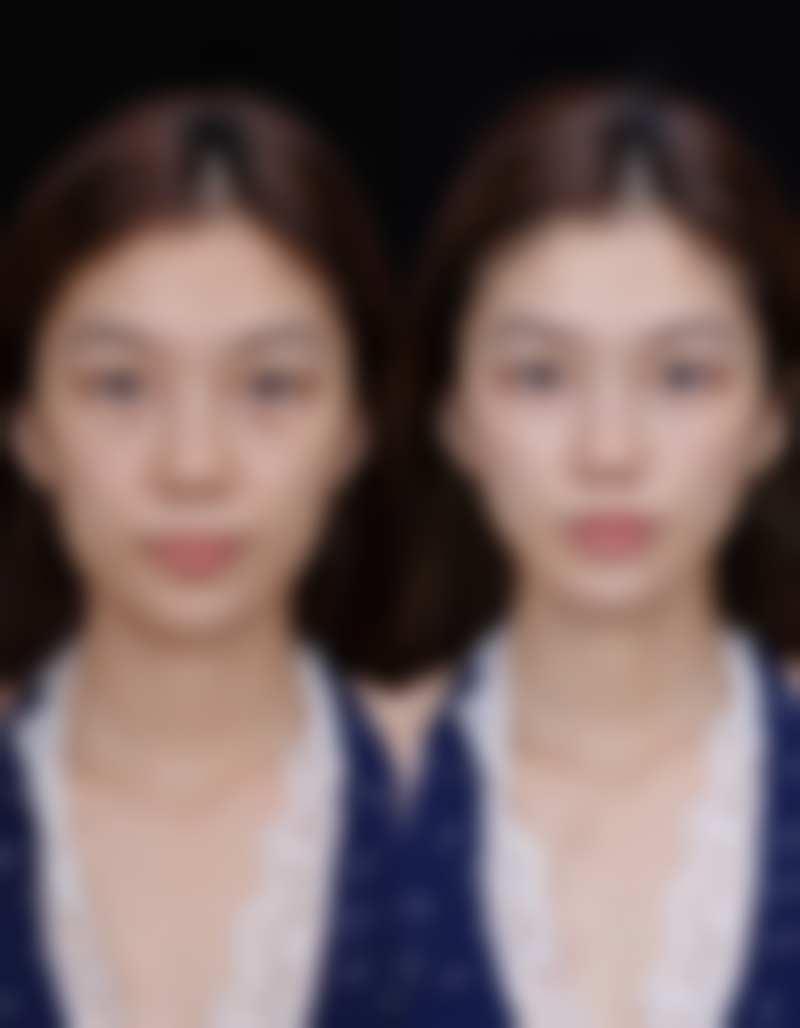 丰太阳穴：适合人群分析