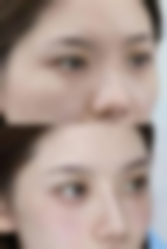 怎样通过手术去眼袋，成效持久又自然？