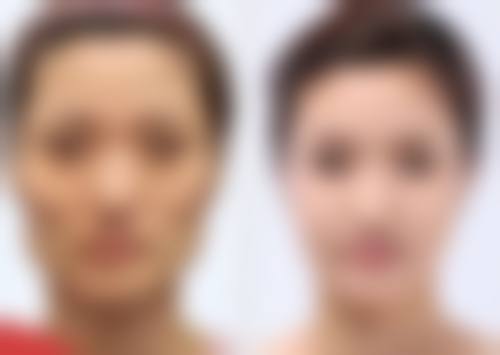 脸上坑疤痕修复指南:选对正规医院,治疗更靠谱