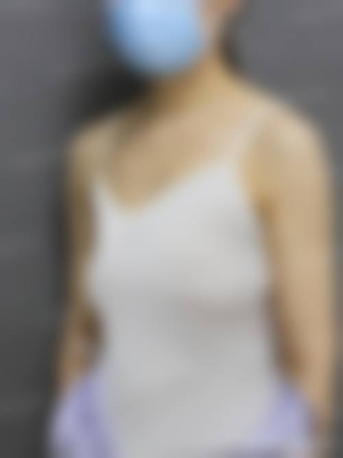 宋晓萍面部轮廓整形实例