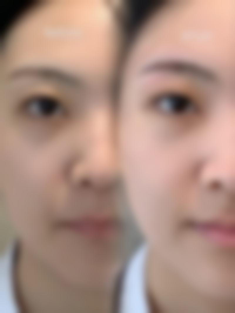 抽脂消肿时间大揭秘!术后护理决定消肿快慢