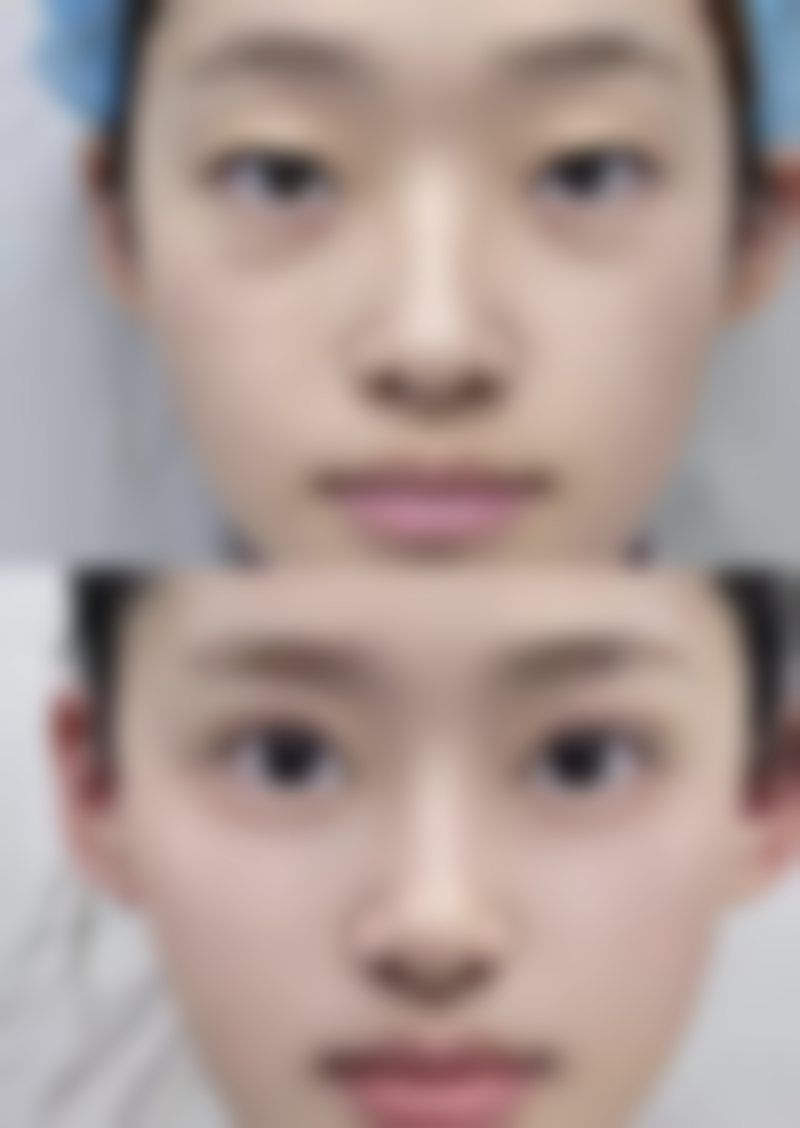 抽脂消肿时间大揭秘!耐心等待收获美丽