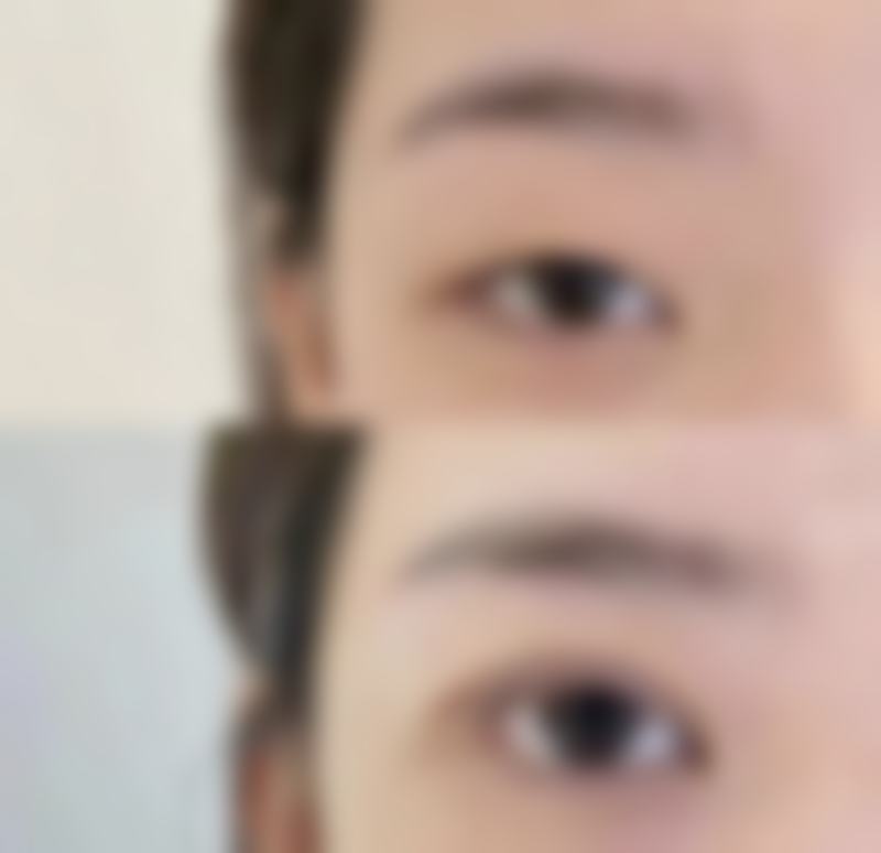 割双眼皮后多久能重返职场?不同工作性质决定上班时间