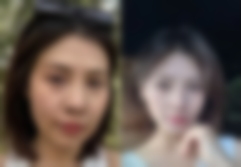 下颌角手术疤痕增生？应对有妙招