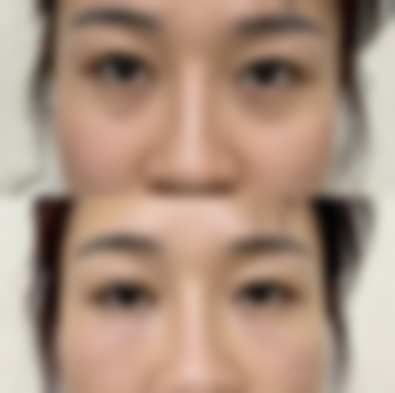 得疤痕疙瘩怎么治疗？坚持就能告别疤痕烦恼