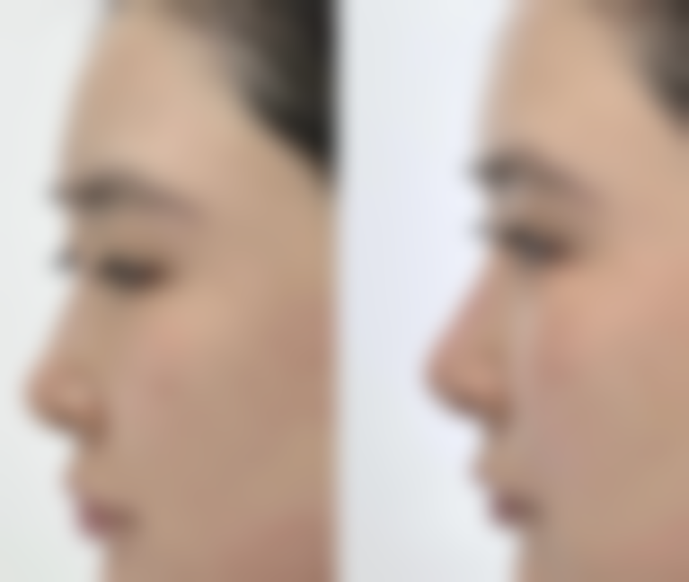 煮鸡蛋去眼袋的操作方法和注意事项