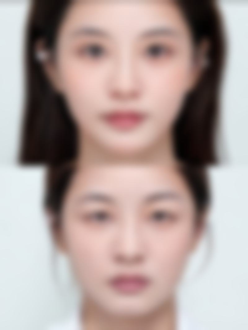 选对医院特别重要，美胸成效有保护