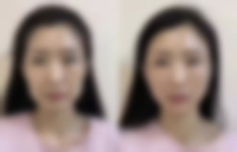 抽脂瘦大腿安心吗？术后护理特别重要