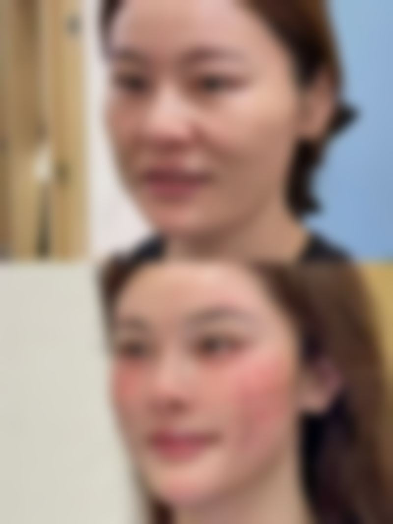 割双眼皮痕迹轻松修复！多方案助你重塑自然美眼，正规医院实力保障 