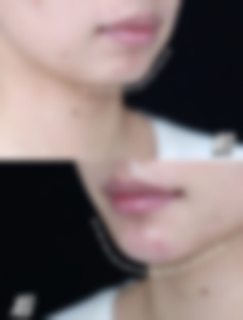 割双眼皮痕迹修复：术后护理与修复建议